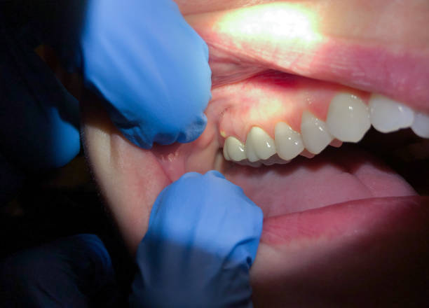Best Emergency Dental Extractions in Ortonville, MI