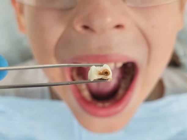 Best Emergency Dentist for Lost Fillings or Crowns in Ortonville, MI