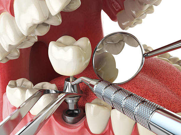 Best Emergency Root Canal Treatment in Ortonville, MI